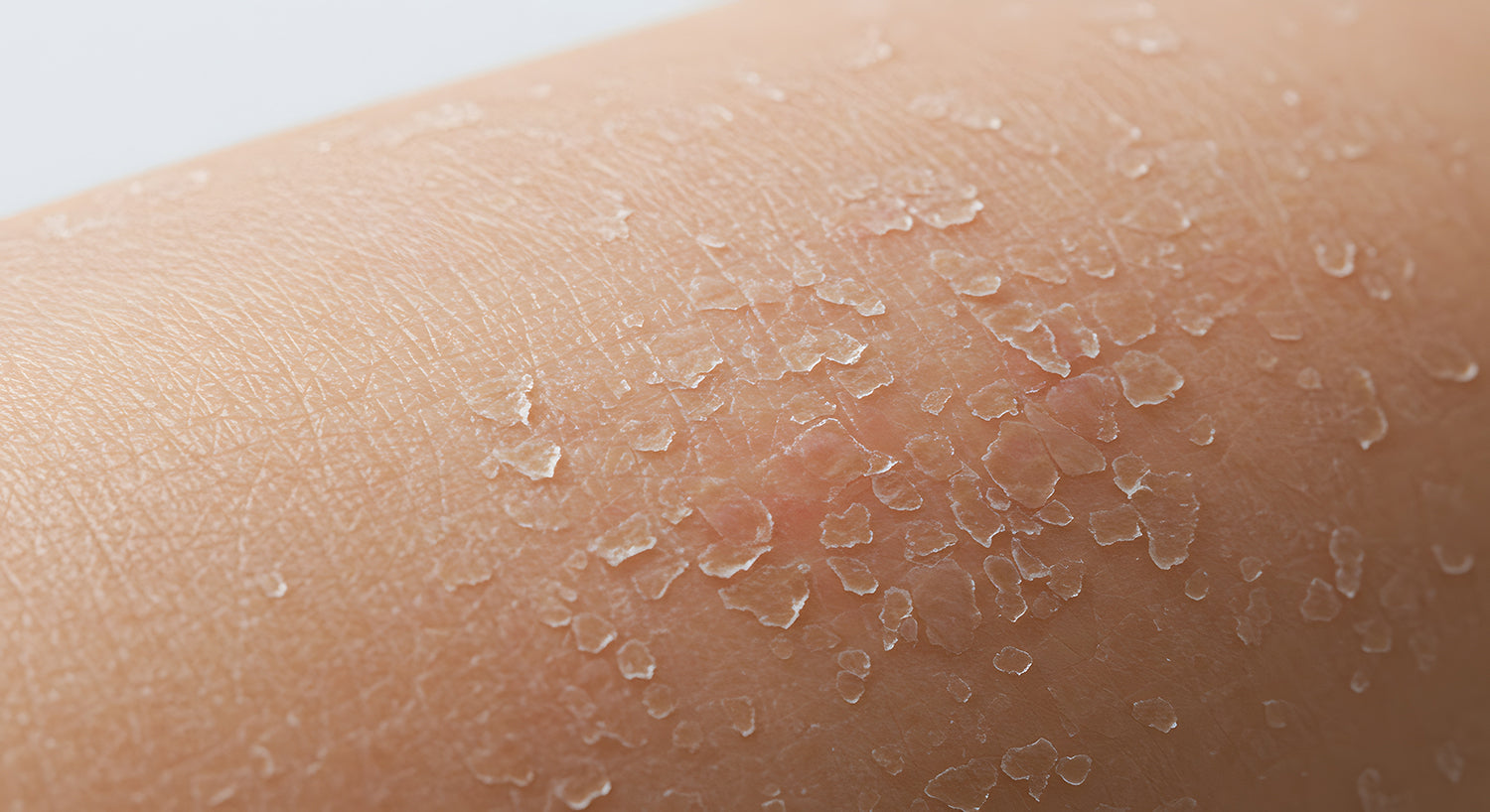 Skin Dryness